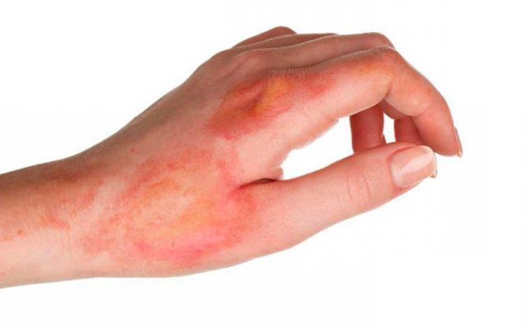 Қазақстандық ғалымдар X-Graft атты жара мен күйікті емдейтін құрал әзірледі