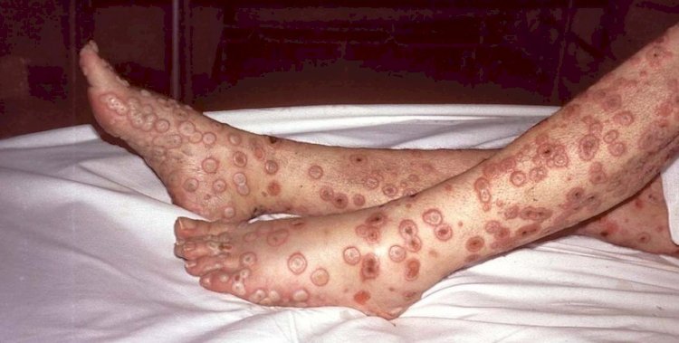 ДДҰ маймыл шешегі маңызы бар төтенше жағдай емес деген қорытынды жасады