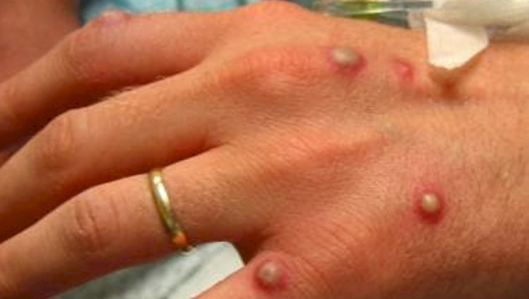 Маймыл шешегі КВИ сияқты кең тарала алмайды