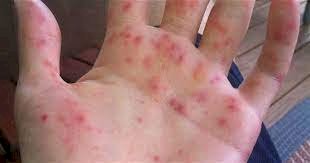 Үндістанда «қызанақ тұмауы» таралып жатыр