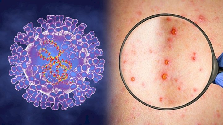 Маймыл шешегіне қарсы заманауи векторлық вакцина жасалды