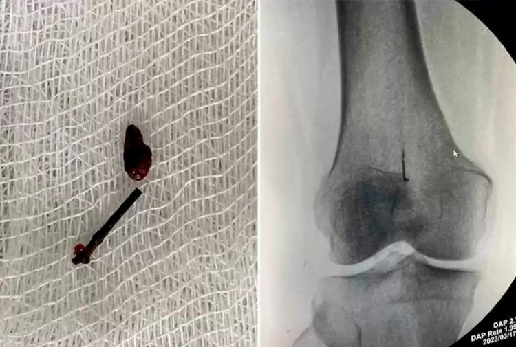 Алматыда 45 жыл бойы тізесіне кірген инемен жүрген әйелге ота жасалды