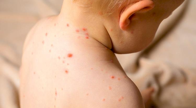 Еліміздің тағы бір өңірінде балалар қызылша дертіне шалдыққан