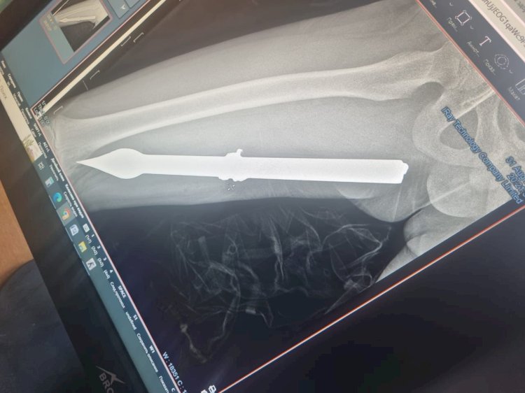 10 жасар баланың аяғына темір істік кіріп кетті