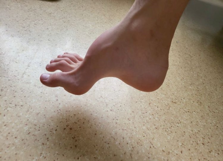 Ат табан балаға операция жасалды