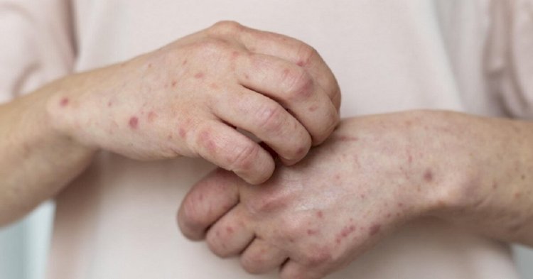 Елімізде қызылша жұқтырудың 10 мыңға жуық жағдайы тіркелген