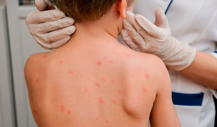 Алматы облысында мыңнан астам адам қызылша жұқтырған