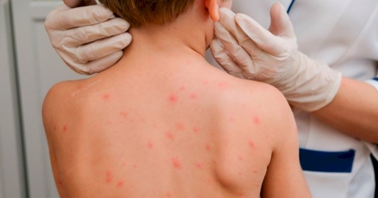 Қазақстанда тырысқақ ауруы үш адамда тіркелді