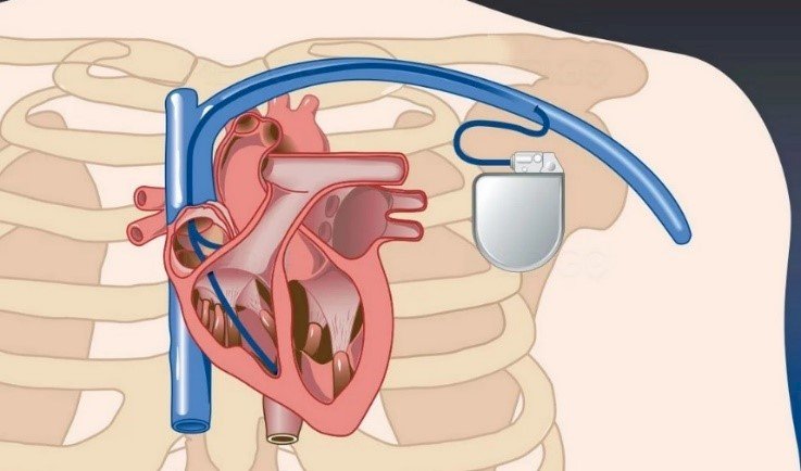 Жүрек ырғағының бұзылыстары  жайлы не білеміз?