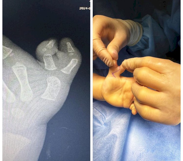 Дәрігерлер  екі жасар сәбидің  артық саусағын алып тастады 