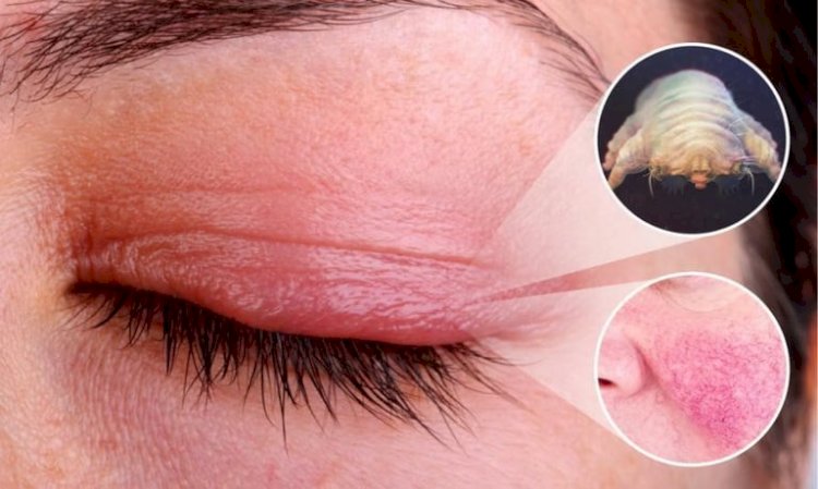 Адамдардың 90%-ның бетінде кене өмір сүреді