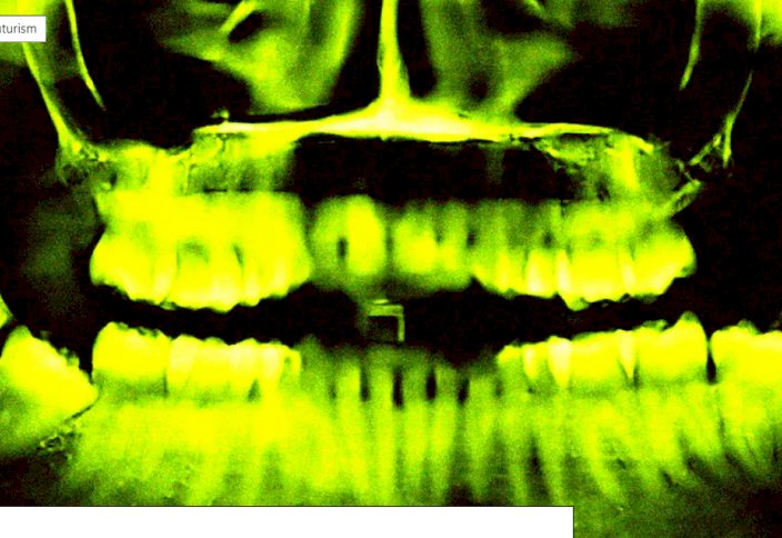 Тіс өсіретін дәрі