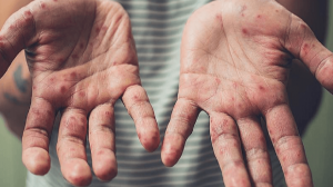 Қазақстанда жыл басынан бері 2 мыңға жуық қызылша дерегі тіркелді