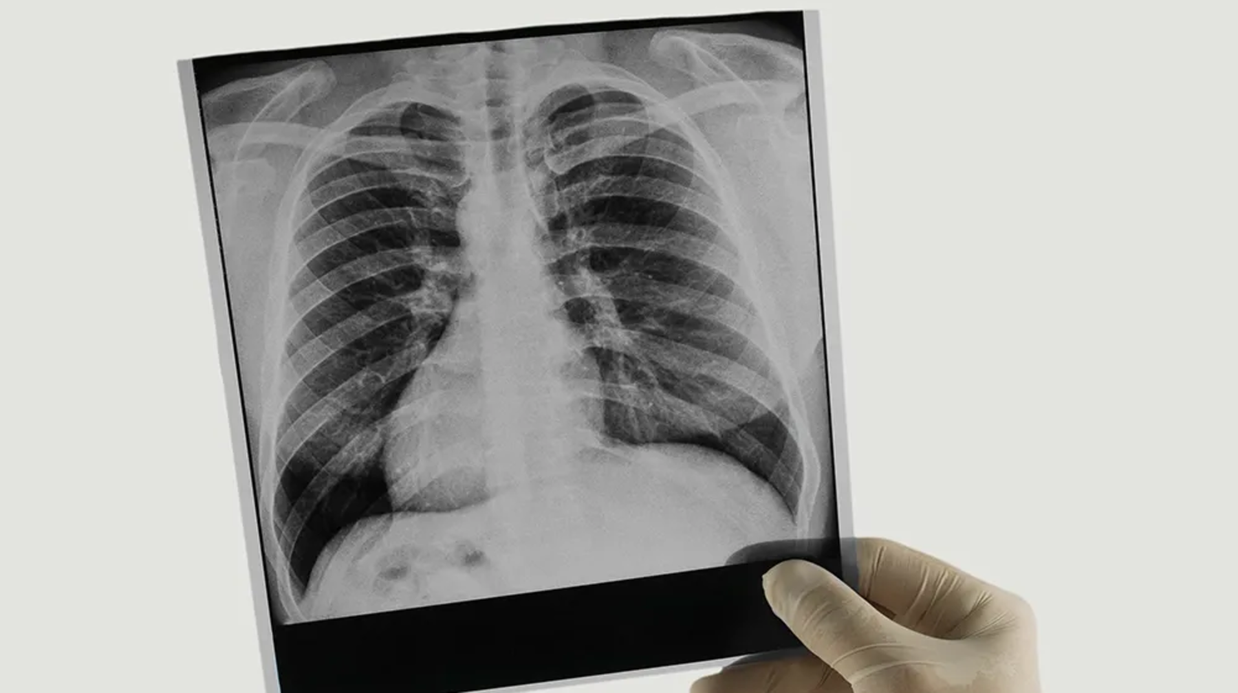 Флюорографиядан өткен 5,6 мыңнана астам адамның 4 мыңынан туберкулез анықталған