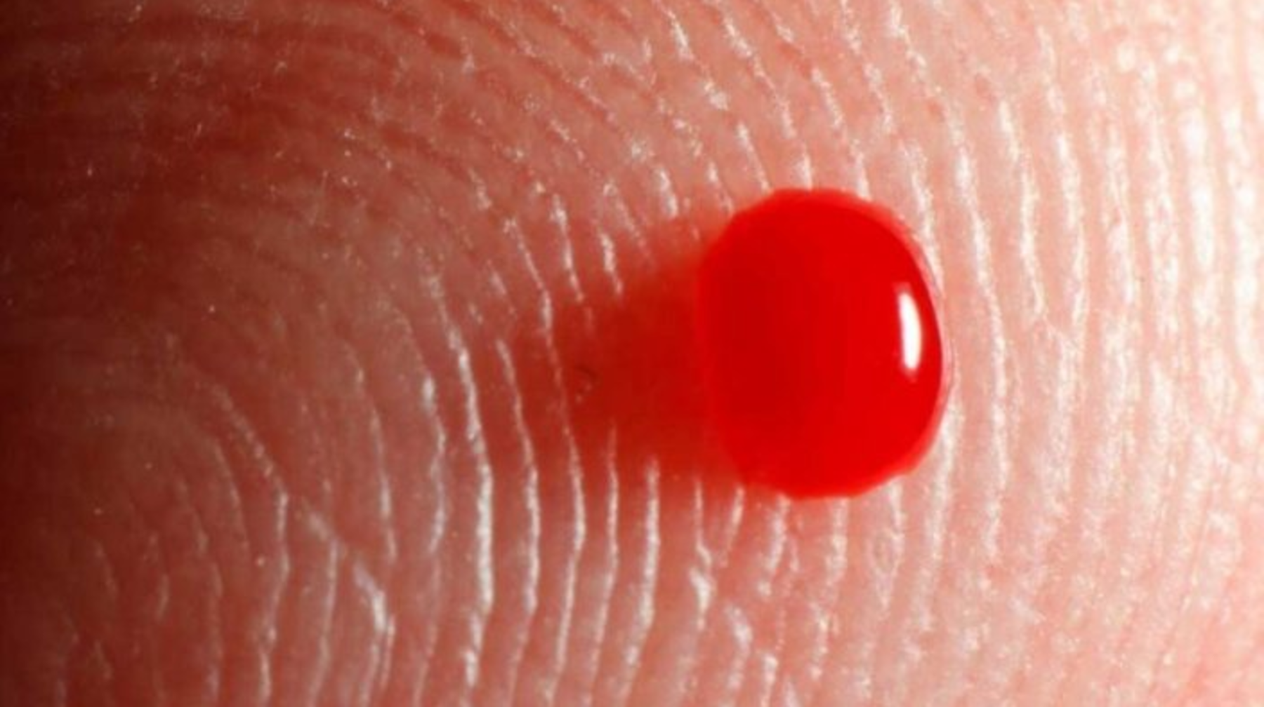 Сирек кездесетін аурулардан адамзаттың әрбір оныншысы зардап шегеді