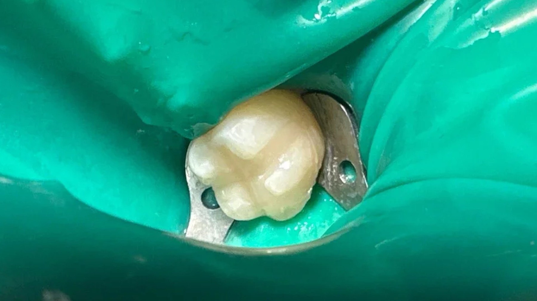 Адамның тісі алғаш рет зертханада сәтті өсірілді