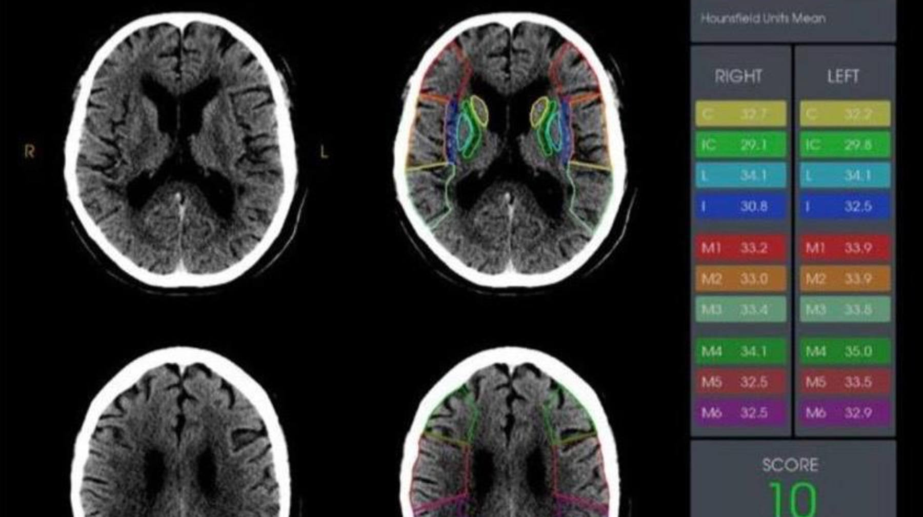 Жасанды интеллект алматылық дәрігерлерге адам өмірін құтқаруға көмектесті