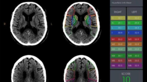Жасанды интеллект алматылық дәрігерлерге адам өмірін құтқаруға көмектесті