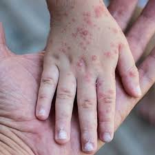 Балалар арасында қызылша өршіп тұр